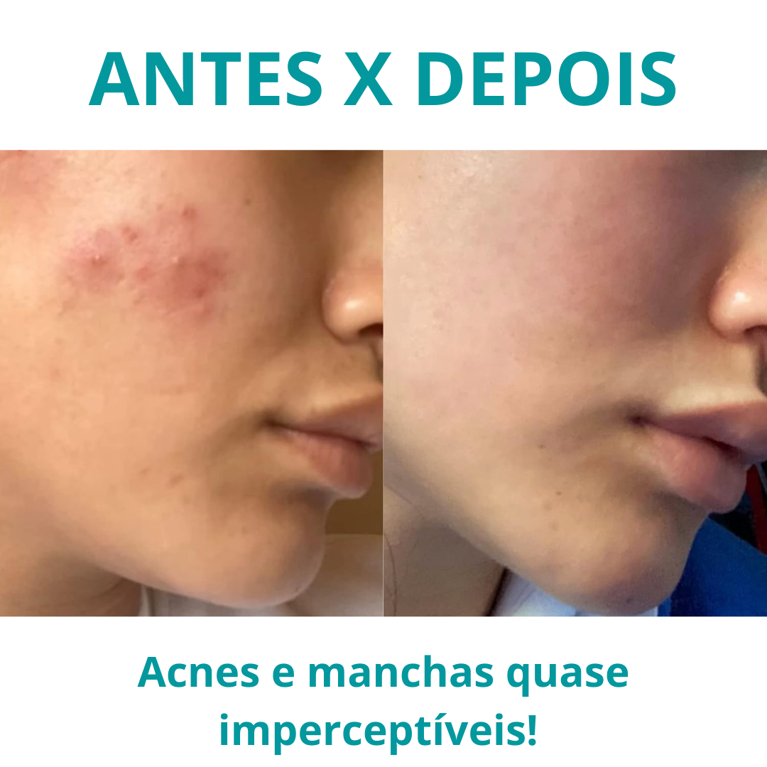 BoosterSkin Pro - Aparelho Facial Coreano